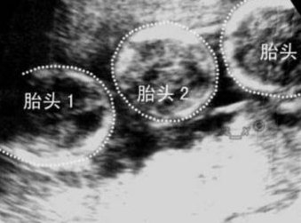 2026中山三代试管助孕的费用总共要多少？从三个方面来了解